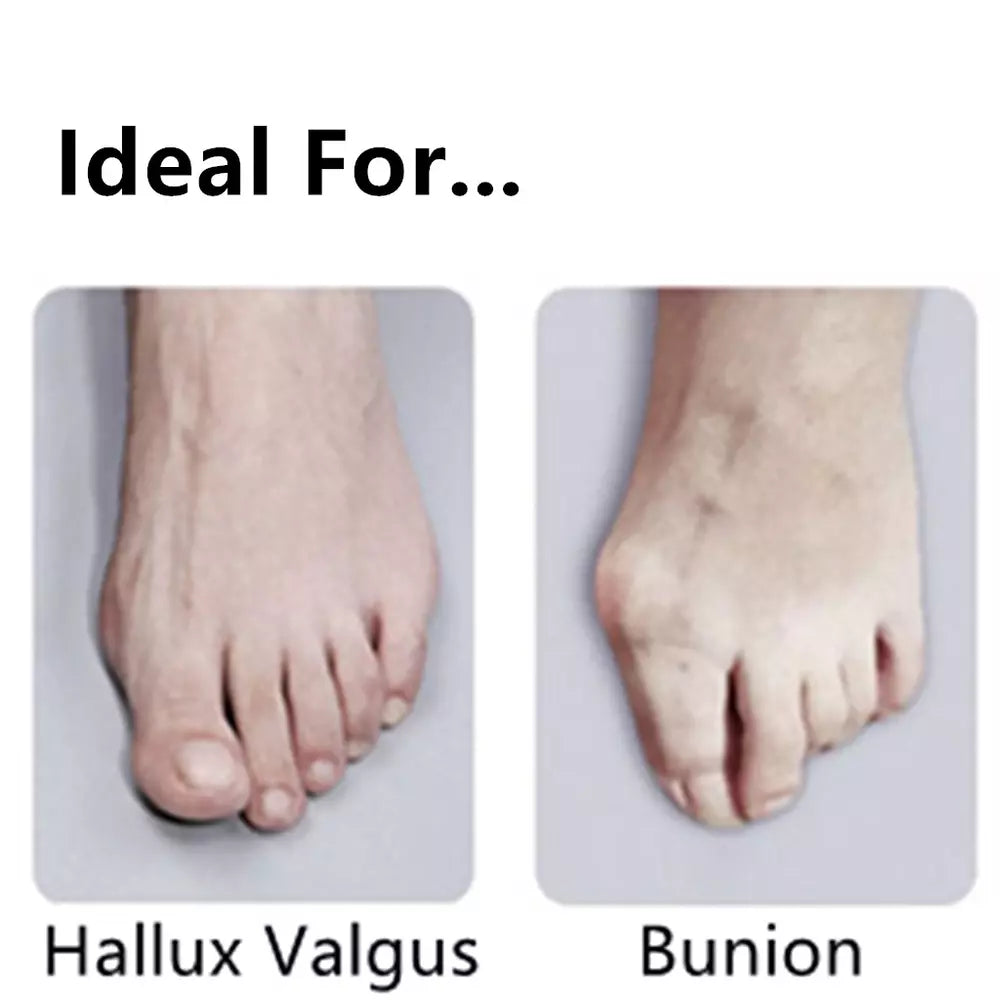 2 Pair Reusable Toe Bunion Hallux Valgus Splint Corrector Foot Pain Relief